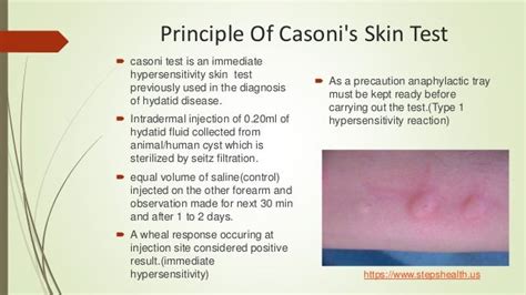 casonic|Parasitology 143 a Casoni Test Skin Hydatid disease  .